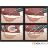 Surgical Crest Splitting Kit. Surgical tips designed for Piezotome®